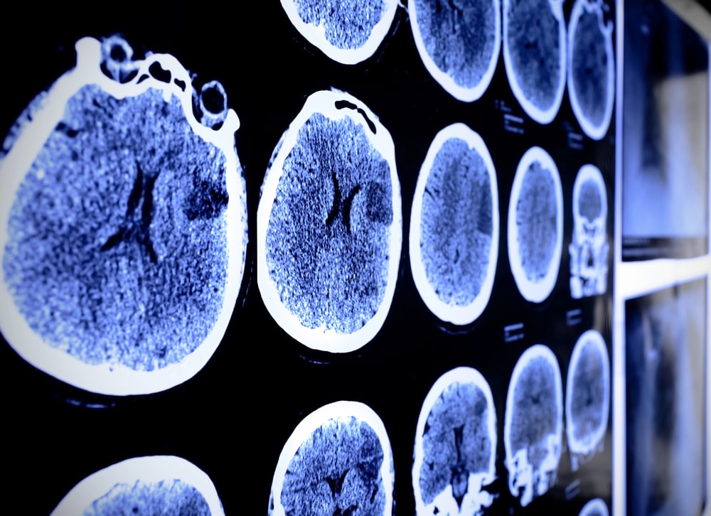 Brain Injury Lawyer Ventura, CA